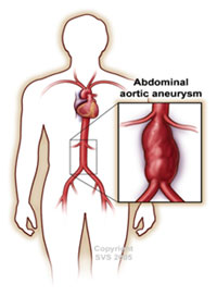 aneurysm1